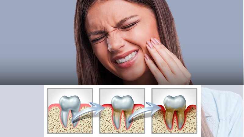 Illustration of tooth decay affecting enamel and gums.